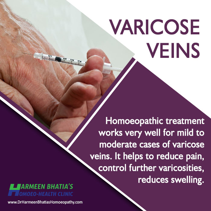 Varicose veins 23