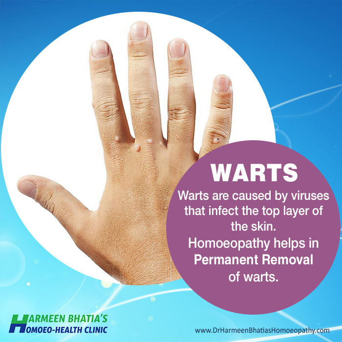 Warts